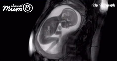 Incredible Ultrasound Shows 20 Week Old Baby In High Definition