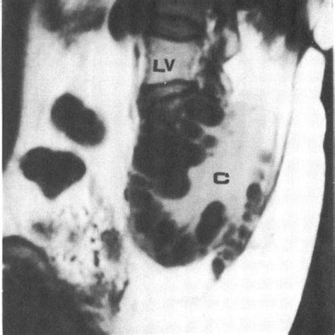 The Magnetic Resonance Imaging Of The Sacral Hydatid Cyst C Cyst