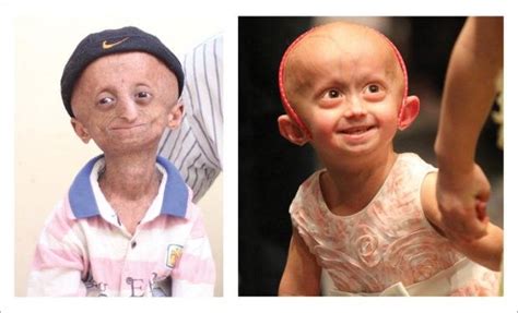 New Clues About Progeria A Disease That Turns Kids Into Old People