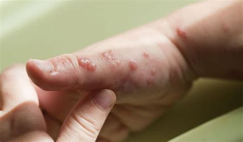 How To Recognize And Treat Shingles Natural Home Remedies Molluscum