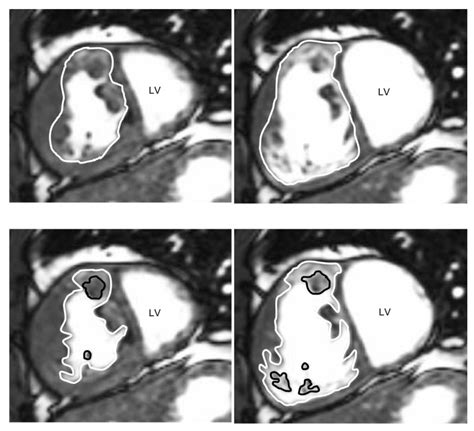 Evaluating The Systemic Right Ventricle By Cmr The Importance Of