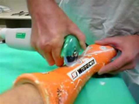 How can i remove a fiberglass arm cast myself? Removing my arm cast - YouTube