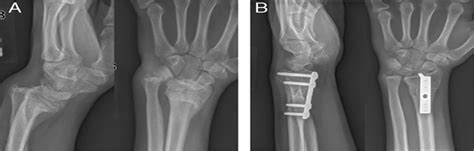 Fractures Of The Distal Radius And Ulna Metaphyseal And Phy