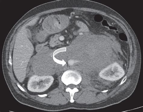 Cross Sectional Imaging Features Of Primary Retroperitoneal Tumors And