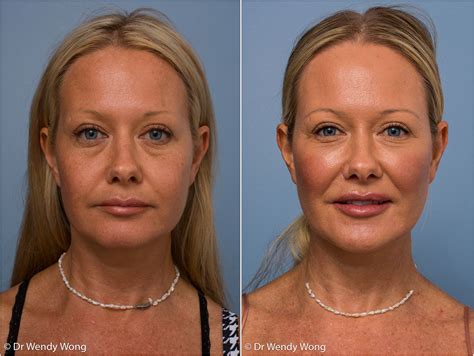 Brisbane Anti Wrinkle Injections Dr Wendy Wong