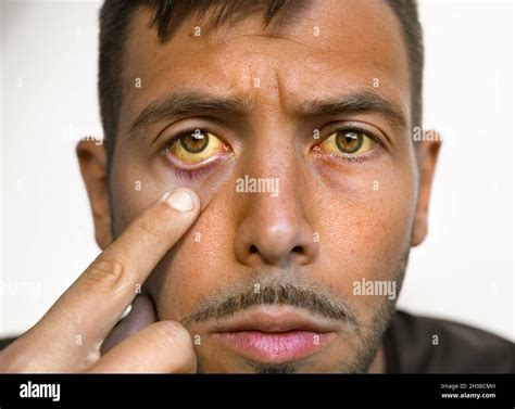 Liver Disease Yellow Eyes Skin Hi Res Stock Photography And Images Alamy