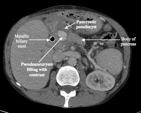 Haemosuccus Pancreaticus The Bmj