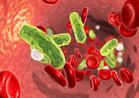 Septicemia is defined as having bacteria in the bloodstream that cause sepsis. Septicaemia Symptoms - Homeopathy Plus