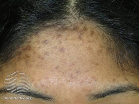 Post Inflammatory Hyperpigmentation And Acne