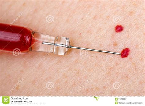 Nevus And Cherry Angioma On Human Skin Royalty Free Stock Image