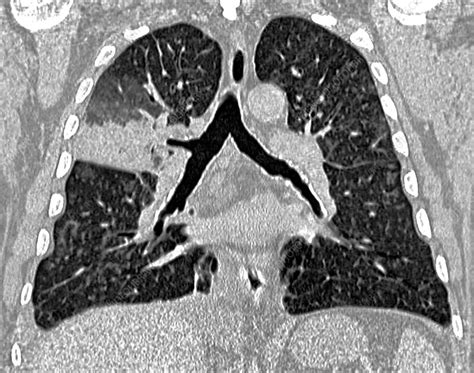 Pneumococcal Pneumonia Ct Scan Stock Image C0294569 Science