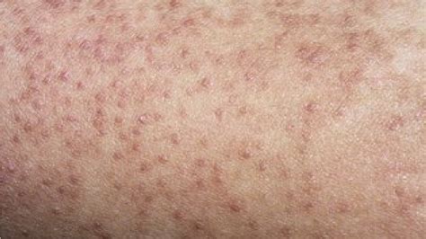 How To Get Rid Of Keratosis Pilaris On Arms Youtube