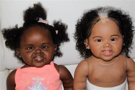 Vitiligo In Babies Pictures Leilani Wilde