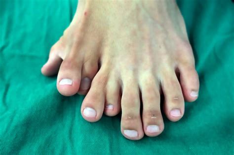 Man Born With Nine Toes Gets Surgery To Remove Extra Digits