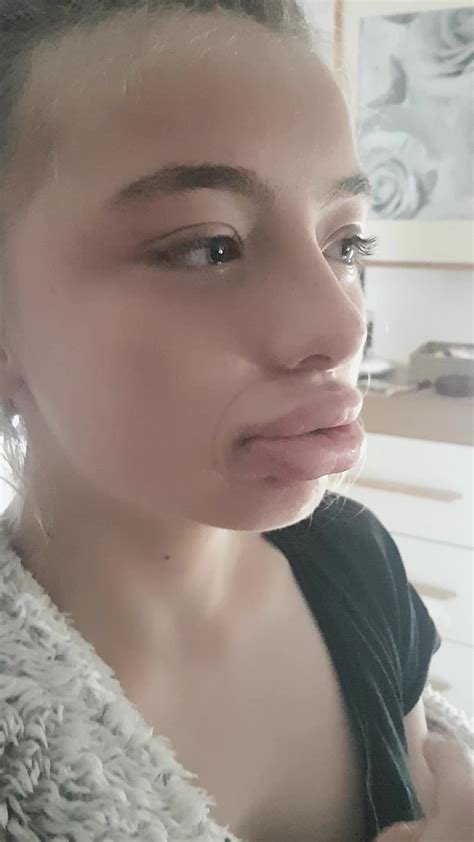 Girl Left With Inflated Lips For Days After Mum Films Her Trying