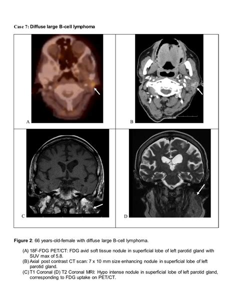 18f Fdg Petct Imaging Features Of Parotid Lesions Case Based