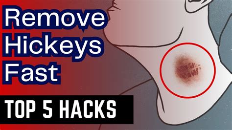 how to remove hickeys fast 5 proven methods that work get rid of hickey quickly youtube