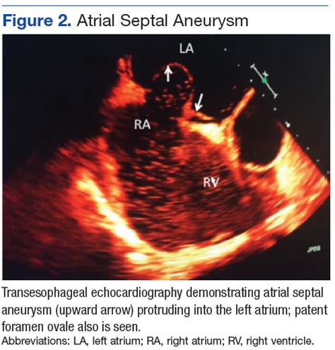 Three Anomalies And A Complication Ruptured Noncoronary Sinus Of