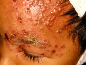 Have systemic antivirals made a herpes zoster ophthalmicus natural history, risk factors, clinical presentation, and morbidity. Herpes zoster | DermNet NZ