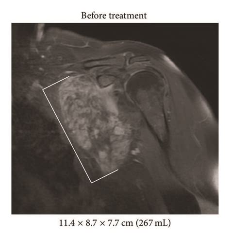 Imaging Of Axillary Desmoid Treatment Response Coronal T1 Postcontrast