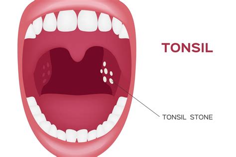 White Spots On Tonsils Causes Symptoms And Treatment Options This
