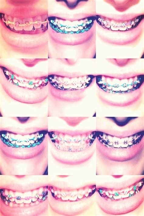 The Best Best Color For Braces Bands References