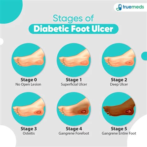 Foot Ulcer Self Care Tips For Diabetics