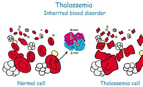 Thalassemia The Difference Of Blood Thalassemia And Normal Blood Red