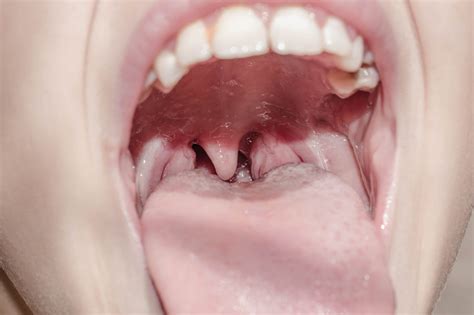 Bumps On The Back Of Tongue Causes Symptoms Treatments