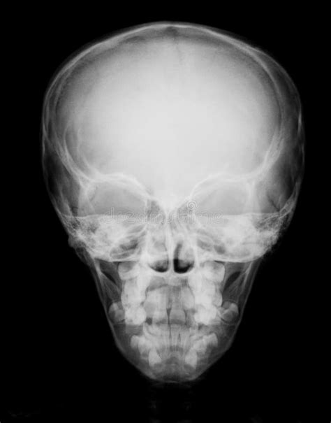 X Ray Image Of Skullpa View Stock Photo Image Of Mandible Skull