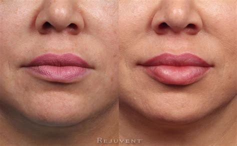 Fullips Before And After