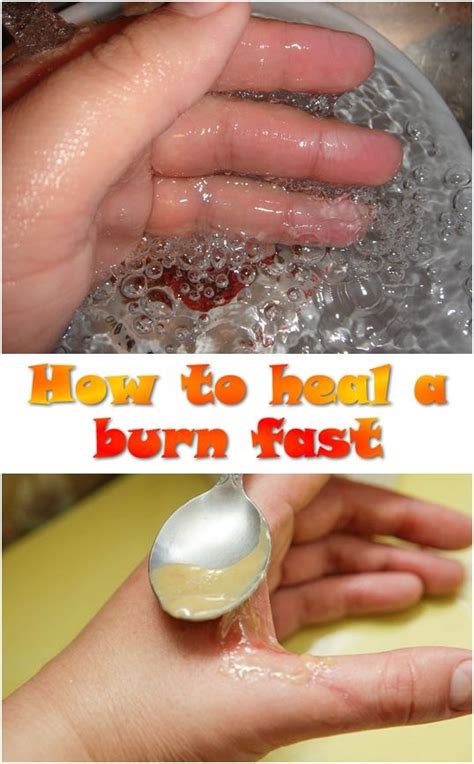 Home Remedies For Burns Collins