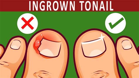 Most ingrown hairs go away on their own. How to Get rid of Ingrown Toenail Naturally | 10 Home ...