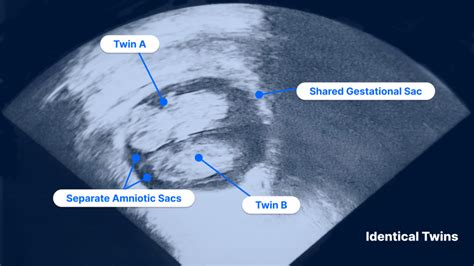 Twin Pregnancy Ultrasound Pockethealth