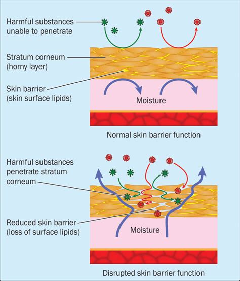 British Journal Of Nursing Moisture Associated Skin Damage Causes