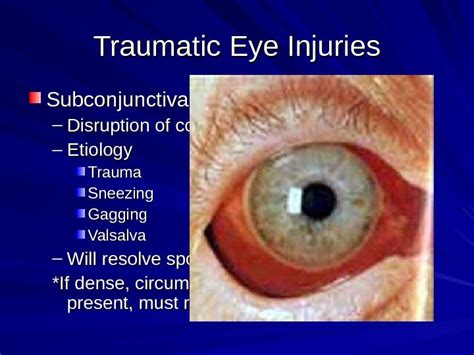 Traumatic Eye Injuries By Barakzay Dastagir Traumatic