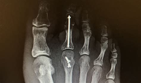 Will I Have Pins In My Foot To Fix A Hammer Toe Dr Nicholas Campitelli