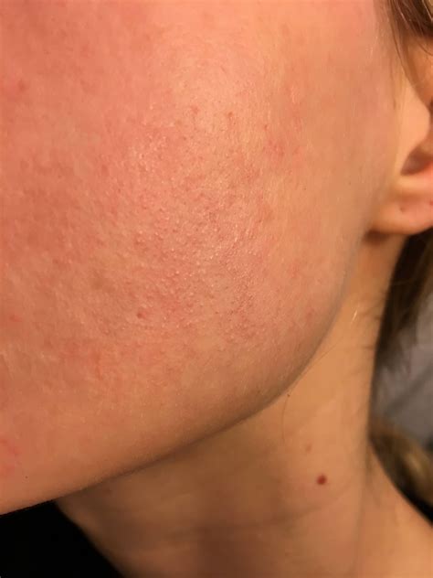 Understanding Teeny Tiny Bumps On Cheeks And Jawline