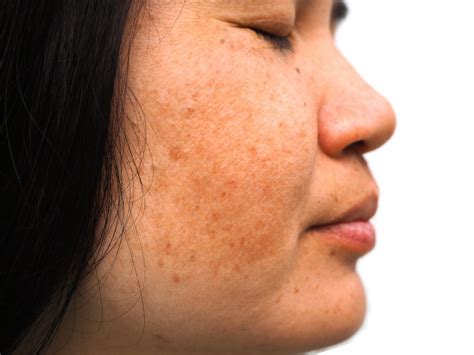 Melasma Wont Go Away After Pregnancy Heres What Experts Advise