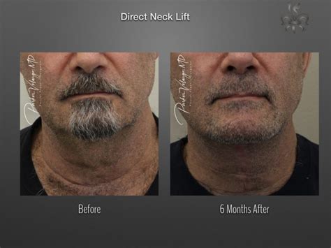 Direct Neck Lift Archives New Orleans Premier Center For Aesthetics And Plastic Surgery