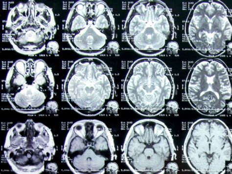 Imaging Study Confirms Differences In Adhd Brains The Medical Republic