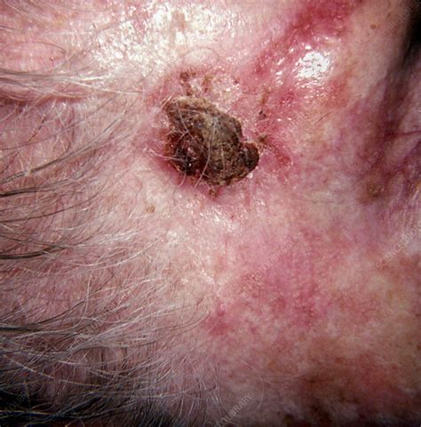 Morphea With Ulceration Stock Image C0222110 Science Photo Library