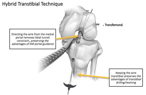 Pursuing Novel Techniques For Acl Reconstruction Advances In Orthopedics Newyork Presbyterian