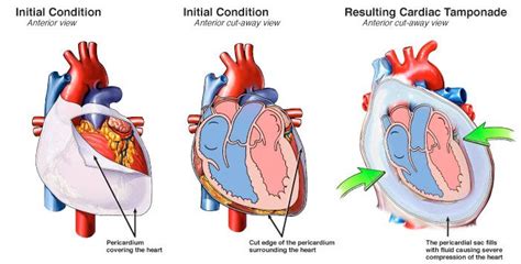 Treating Cardiac Tamponade