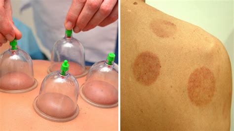 What Is Cupping Treatment Man Left With Bruises After Cupping Allure