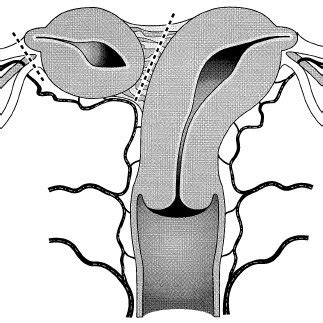 Rudimentary Horn Attached To The Unicornuate Uterus By Band Of Tissue Download Scientific
