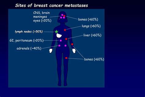 Ppt Adjuvant Therapy For Early Breast Cancer Subtypes Joyce O
