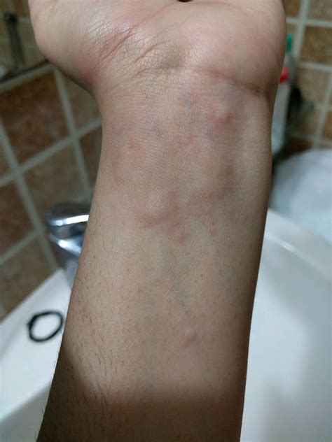 Bumps On Skin It Gets All Over Body Please Suggest Medicine