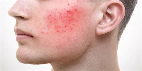Is It Acne Or Rosacea Best Skin Care Australia