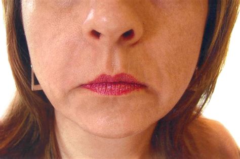 Dermal Lip And Face Fillers Abate Medispa Sanctuary